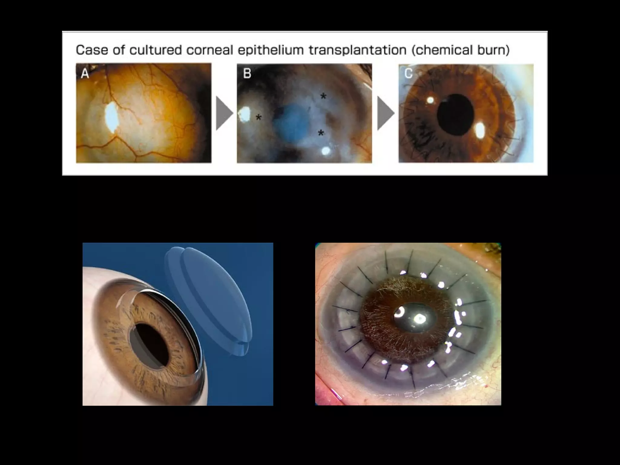 Eye Deficiency Vitamin A Deficiency | PPS