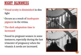 NIGHT BLINDNESS
 Visual acuity is diminished in dim
light
 Occurs as a result of inadequate
pigment in the retina.
 The dark adaptation time is
increased
 Found in pregnant women in some
instances, especially during the last
trimester of pregnancy when the
vitamin A needs are increased.
 