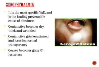 It is the most specific VAD, and
is the leading preventable
cause of blindness
 Conjunctiva becomes dry,
thick and wrinkled
 Conjunctiva gets keratinized
and loses its normal
transparency
 Cornea becomes glazy &
lusterless
XEROPHTHALMIA
 