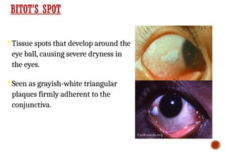 BITOT’S SPOT
Tissue spots that develop around the
eye ball, causing severe dryness in
the eyes.
Seen as grayish-white triangular
plaques firmly adherent to the
conjunctiva.
 