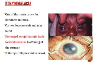 KERATOMALACIA
 One of the major cause for
blindness in India.
 Cornea becomes soft and may
burst
 Prolonged xerophthalmia leads
to keratomalacia (softening of
the cornea)
 If the eye collapses vision is lost.
 