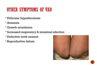  Follicular hyperkeratosis
 Anorexia
 Growth retardation
 Increased respiratory & intestinal infection
 Defective tooth enamel
 Reproductive failure.
OTHER SYMPTOMS OF VAD
 