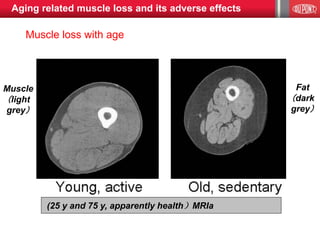 Muscle
（light
grey）
Fat
（dark
grey）
Roubenoff R et al.（2003）《老年学杂志》第58卷第11期，第1012-1017页，2003
(25 y and 75 y, apparently health）MRIa
Muscle loss with age
Aging related muscle loss and its adverse effects
 