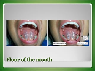 Floor of the mouth 