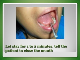 Let stay for 1 to 2 minutes, tell the patient to close the mouth 