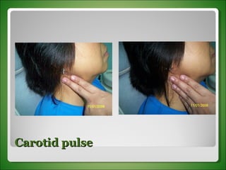 Carotid pulse 