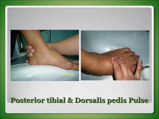 Posterior tibial & Dorsalis pedis Pulse 