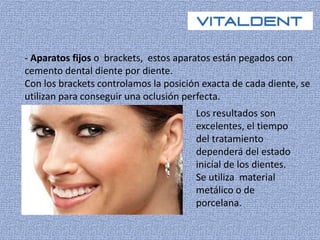 - Aparatos fijos o brackets, estos aparatos están pegados con 
cemento dental diente por diente. 
Con los brackets controlamos la posición exacta de cada diente, se 
utilizan para conseguir una oclusión perfecta. 
Los resultados son 
excelentes, el tiempo 
del tratamiento 
dependerá del estado 
inicial de los dientes. 
Se utiliza material 
metálico o de 
porcelana. 
 