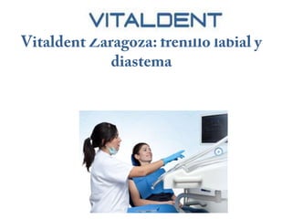 Vitaldent Zaragoza: frenillo labial y diastema