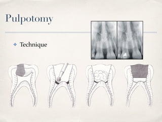Pulpotomy
✤ Technique
 