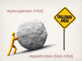 Apexogenesis (Vital)
Apexification (Non-Vital)
 