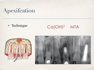 Apexifcation
✤ Technique
Ca(OH)2 MTA
 