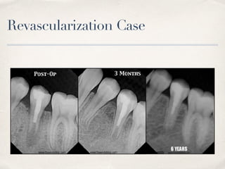 Revascularization Case
 
