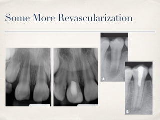 Some More Revascularization
 