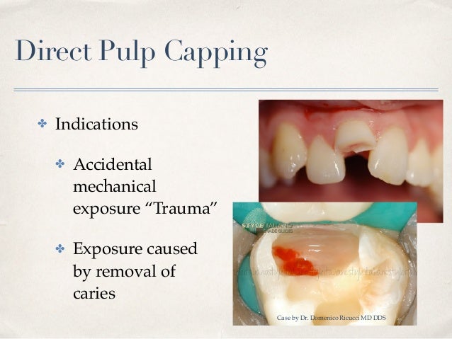 vital pulp therapy direct pulp cap
