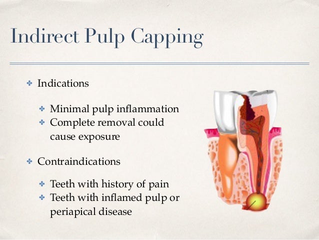 indirect pulp cap