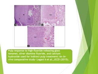 Pulp response to high fluoride releasing glass
ionomer, silver diamine fluoride, and calcium
hydroxide used for indirect pulp treatment: An in-
vivo comparative study- Logani A et al.,JCCD (2015).
 