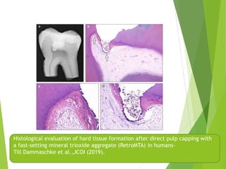 Histological evaluation of hard tissue formation after direct pulp capping with
a fast-setting mineral trioxide aggregate (RetroMTA) in humans-
Till Dammaschke et al.,JCOI (2019).
 