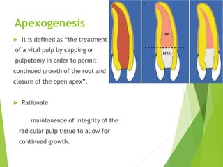Apexogenesis
 It is defined as “the treatment
of a vital pulp by capping or
pulpotomy in order to permit
continued growth of the root and
closure of the open apex”.
 Rationale:
maintanence of integrity of the
radicular pulp tissue to allow for
continued growth.
 