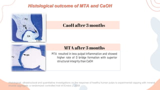 MTA resulted in less pulpal inflammation and showed
higher rate of D bridge formation with superior
structural integrity than CaOH
CaoH after 3 months
Histological outcome of MTA and CaOH
MTA after 3 months
Histological, ultrastructural and quantitative investigations on the response of healthy human pulps to experimental capping with mineral
trioxide aggregate: a randomized controlled trial Int Endod J. 2008
 