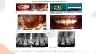 Bhat, et al.: Biodentine: The new bioactive material for direct pulp capping
 
