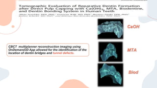 CaOH
MTA
Biod
CBCT multiplanner reconstruction imaging using
OnDemand3D App allowed for the identification of the
location of dentin bridges and tunnel defects.
 