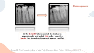 At the 6-month follow-up visit, the tooth was
asymptomatic and tested vital and a reparative
barrier had formed and the canal was not calcified
Endosequence
Trope M. The Expanding Role of Vital Pulp Therapy., Dent Today. 2016 Jun;35(6):82-5.
 
