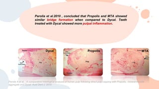 Parolia et al.2010 , concluded that Propolis and MTA showed
similar bridge formation when compared to Dycal. Teeth
treated with Dycal showed more pulpal inflammation.
Dycal Propolis MTA
Parolia A et al, . A comparative histological analysis of human pulp following direct pulp capping with Propolis, mineral trioxide
aggregate and Dycal. Aust Dent J. 2010
 