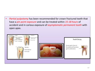 vital pulp therapy endodontics dentistry India | PPTX