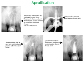 vital pulp therapy endodontics dentistry India | PPTX