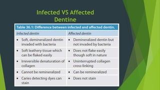 Infected VS Affected
Dentine
 