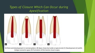 Types of Closure Which Can Occur during
Apexification
 