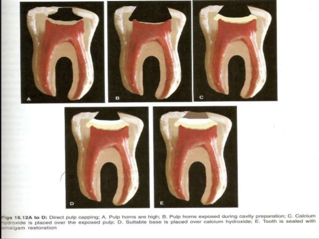 Vital pulp therapy in primary and permanent tooth
