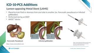 © Health Catalyst. Confidential and Proprietary.
ICD-10-PCS Additions
Lumen-apposing Metal Stent (LAMS)
• Placed to train fluid or absesses from one tube to another (ex. Pancreatic pseudocyst or infected
gallbladder)
• Performed during an ERCP
• AXIOS™ device
https://www.brighamhealthonamission.org/
2019/12/11/pioneering-uses-of-lumen-
apposing-metal-stents-lams/
https://www.sciencedirect.com
Pancreatic Pseudocyst Infected gallbladder
 