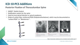 © Health Catalyst. Confidential and Proprietary.
ICD-10-PCS Additions
Posterior Fixation of Thoracolumbar Spine
• VADER® Pedicle System
• Stabilization system for the spine
• Used to treat spinal infection or spinal neoplasms
• Made of carbon fiber reinforced PEEK (Polyeteretherketone), which may be documented as
“carbon/PEEK” or “BlackArmor ®.
https://www.icotec-medical.com/en-us/implants/vader-pedicle-system/
 