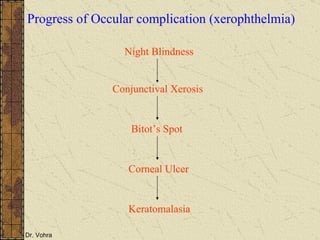 Progress of Occular complication (xerophthelmia) Keratomalasia Night Blindness Conjunctival Xerosis Bitot’s Spot Corneal Ulcer 