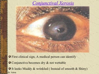 First clinical sign, A medical person can identify Conjunctiva becomes dry & not wettable It looks Muddy & wrinkled ( Instead of smooth & Shiny) Conjunctival Xerosis 