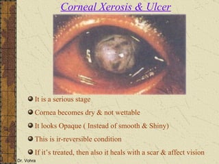 It is a serious stage Cornea becomes dry & not wettable It looks Opaque ( Instead of smooth & Shiny) This is ir-reversible condition If it’s treated, then also it heals with a scar & affect vision Corneal Xerosis & Ulcer 