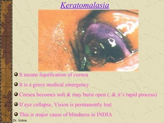 It means liquification of cornea It is a grave medical emergency Cornea becomes soft & may burst open (..& it’s rapid process) If eye collapse, Vision is permanently lost This is major cause of blindness in INDIA Keratomalasia 