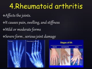 4.Rheumatoid arthritis
Affects the joints.
It causes pain, swelling, and stiffness
Mild or moderate forms
Severe form , serious joint damage
 