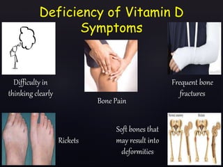 Deficiency of Vitamin D
Symptoms
Difficulty in
thinking clearly
Bone Pain
Frequent bone
fractures
Soft bones that
may result into
deformities
Rickets
 
