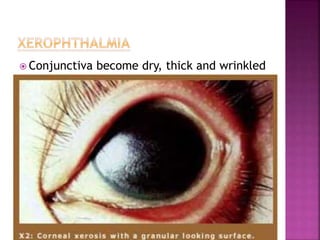  Conjunctiva become dry, thick and wrinkled
 