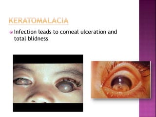  Infection leads to corneal ulceration and
total blidness
 