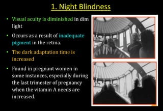 1. Night Blindness
• Visual acuity is diminished in dim
light
• Occurs as a result of inadequate
pigment in the retina.
• The dark adaptation time is
increased
• Found in pregnant women in
some instances, especially during
the last trimester of pregnancy
when the vitamin A needs are
increased.
 