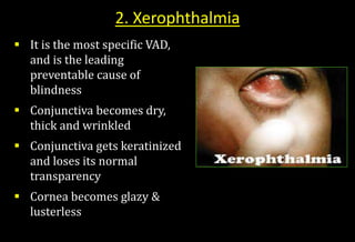  It is the most specific VAD,
and is the leading
preventable cause of
blindness
 Conjunctiva becomes dry,
thick and wrinkled
 Conjunctiva gets keratinized
and loses its normal
transparency
 Cornea becomes glazy &
lusterless
2. Xerophthalmia
 