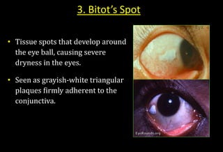 3. Bitot’s Spot
• Tissue spots that develop around
the eye ball, causing severe
dryness in the eyes.
• Seen as grayish-white triangular
plaques firmly adherent to the
conjunctiva.
 