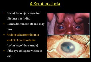 4.Keratomalacia
• One of the major cause for
blindness in India.
• Cornea becomes soft and may
burst
• Prolonged xerophthalmia
leads to keratomalacia
(softening of the cornea)
• If the eye collapses vision is
lost.
 
