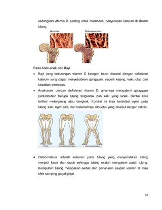 10
sedangkan vitamin D penting untuk membantu penyerapan kalsium di dalam
tulang.
Pada Anak-anak dan Bayi
 Bayi yang kekurangan vitamin D kategori berat ditandai dengan defisiensi
kalsium yang dapat menyebabkan gangguan, seperti kejang, kaku otot, dan
kesulitan bernapas.
 Anak-anak dengan defisiensi vitamin D umumnya mengalami gangguan
pertumbuhan berupa tulang tengkorak dan kaki yang lunak. Bentuk kaki
terlihat melengkung atau bengkok. Kondisi ini bisa berakibat nyeri pada
tulang kaki, nyeri otot, dan melemahnya otot-otot yang disebut dengan rakitis.
 Osteomalasia adalah kelainan pada tulang yang menyebabkan tulang
menjadi lunak dan rapuh sehingga tulang mudah mengalami patah tulang.
Kerapuhan tulang merupakan akibat dari penurunan asupan vitamin D atau
efek samping gagal ginjal.
 