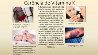 Carência de Vitamina K
A deficiência de vitamina K não
é muito comum, pois a vitamina
é bastante distribuída nos
alimentos e é produzido pelos
microorganismos do intestino .
Porém sua deficiência está
associada com a mal absorção
de lipídeos ou destruição da
flora intestinal por uso de
antibiótico continuamente. Os
principais sintomas são as
hemorragias da pele, do nariz,
de uma ferida ou do estômago,
acompanhadas de vômitos.
Pode-se observar sangue na
urina ou nas fezes. Em casos
mais graves, pode produzir-se
hemorragia cerebral nos recém-
nascidos.
A vitamina K auxiliando na
coagulação sanguínea
Recém-nascidos recebem vitamina
K após o nascimento porque
nascem com pouca vitamina k. A
falta deste vitamina pode levar a
hemorragia
hemorragia do nariz
hemorragias da pele
 