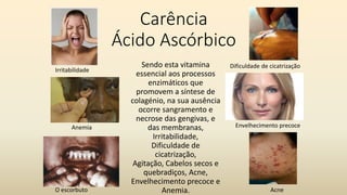 Carência
Ácido Ascórbico
Sendo esta vitamina
essencial aos processos
enzimáticos que
promovem a síntese de
colagénio, na sua ausência
ocorre sangramento e
necrose das gengivas, e
das membranas,
Irritabilidade,
Dificuldade de
cicatrização,
Agitação, Cabelos secos e
quebradiços, Acne,
Envelhecimento precoce e
Anemia.
O escorbuto
Irritabilidade
Envelhecimento precoce
Acne
Dificuldade de cicatrização
Anemia
 